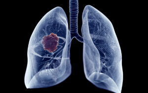 Former England Cricketer Raises Awareness After Shock Lung Cancer Diagnosis