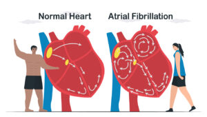 New Trial Suggests Select AFib Patients Can Stop Blood Thinners After Ablation