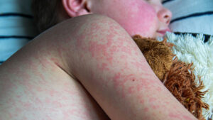 Global Measles Cases Plunge as Vaccination Rates Strengthen Worldwide, WHO Reports