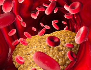 New Research Links Very Low LDL Cholesterol Levels to Higher Diabetes Risk