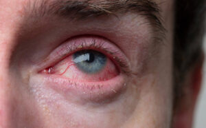 Eye Bacteria Linked to Alzheimer’s Risk in Groundbreaking Study