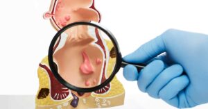 Europe Approves Zynyz: First Immunotherapy Option for Advanced Anal Cancer Patients