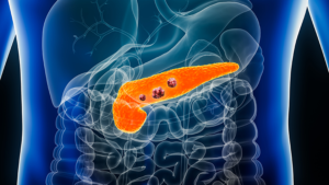 Pancreatic Cancer Breakthrough: New Therapy Triggers Significant Tumor Shrinkage in Study