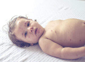 Promising Decline: South Carolina Health Officials Report Major Drop in Recent Measles Infections