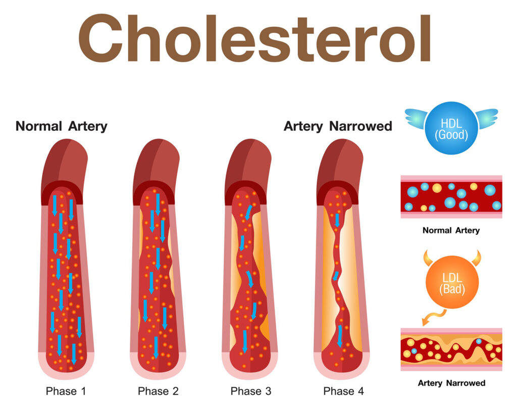 New Heart Health Guidelines Urge Lower Cholesterol Targets and Earlier Medical Intervention