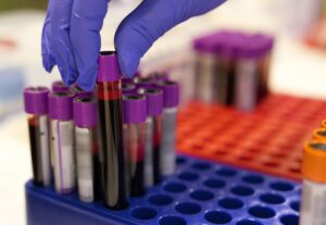 New Blood Test Links Gut Health to Early Dementia Detection