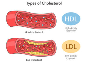 New Medical Study Proves Aggressive Cholesterol Reduction Significantly Cuts Heart Attack Risk