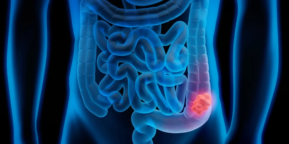 Colorectal Cancer Becomes Leading Cause of Cancer Death for Younger Adults Under 50