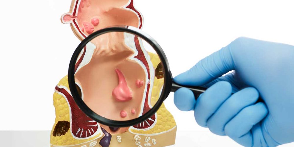 Europe Approves Zynyz: First Immunotherapy Option for Advanced Anal Cancer Patients