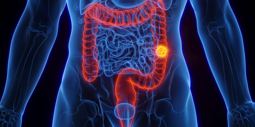 Giant Inflatable Bowel Set to Tour Leicester to Raise Cancer Awareness