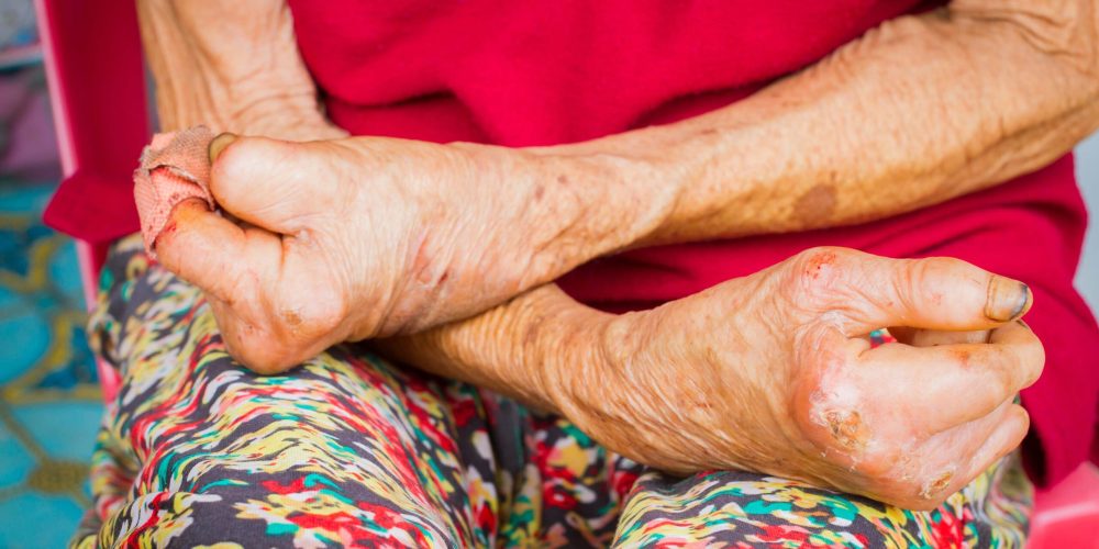 Global Health Leaders Fast-Track New Strategy to Eradicate Leprosy by 2030