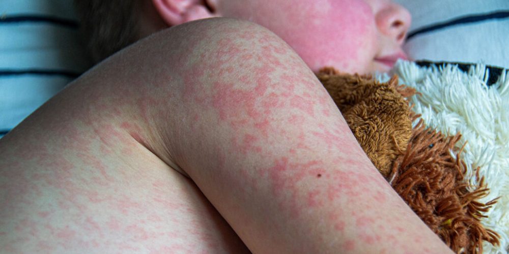 Global Measles Cases Plunge as Vaccination Rates Strengthen Worldwide, WHO Reports