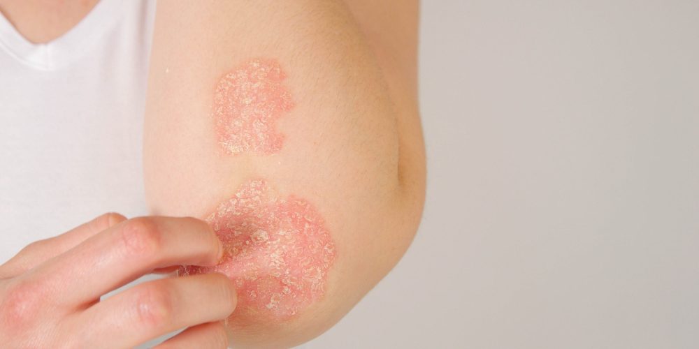 Interleukin-17 Inflammation Axis Emerges as Primary Target for New Skin Disease Treatments
