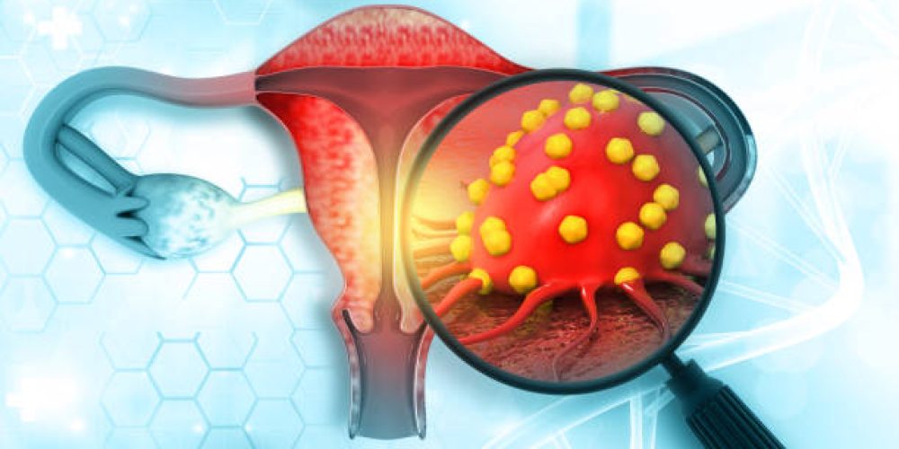 Major Cervical Cancer Screening Guidelines Shift: New Start Age and Self-Testing Option