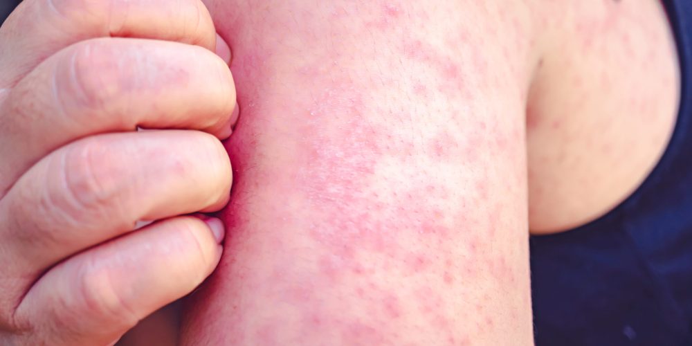 Measles Makes a Global Comeback as Falling Vaccination Rates Fuel New Outbreaks