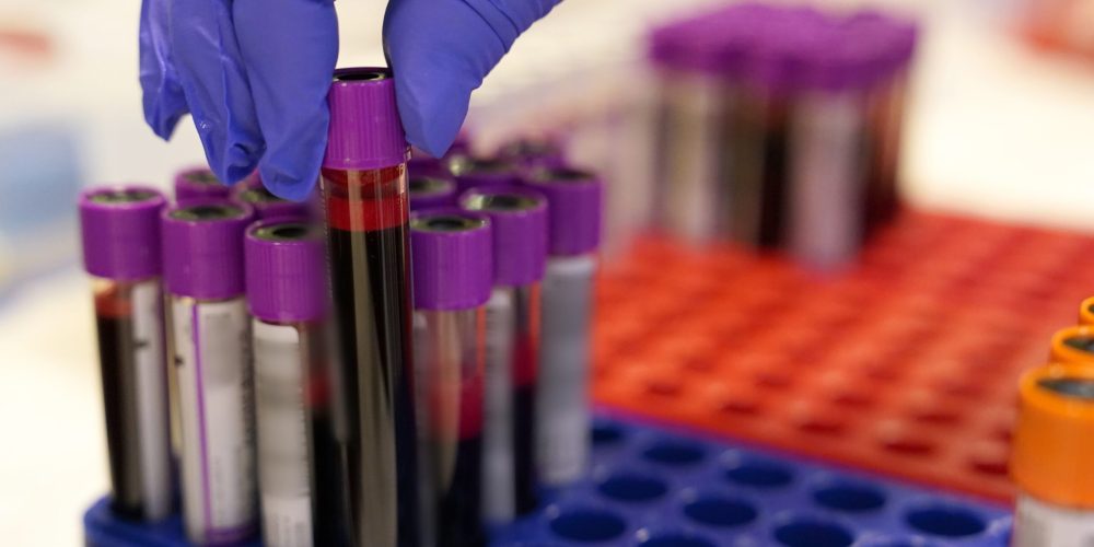 New Blood Test Links Gut Health to Early Dementia Detection