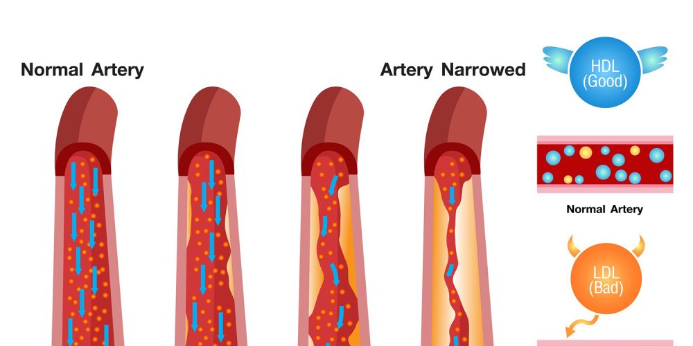 New Heart Health Guidelines Urge Lower Cholesterol Targets and Earlier Medical Intervention
