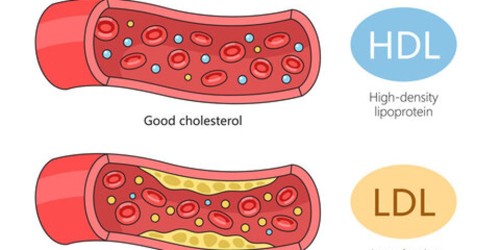 New Medical Study Proves Aggressive Cholesterol Reduction Significantly Cuts Heart Attack Risk