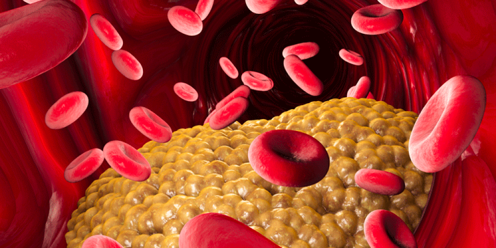New Research Links Very Low LDL Cholesterol Levels to Higher Diabetes Risk
