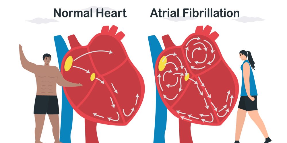 New Trial Suggests Select AFib Patients Can Stop Blood Thinners After Ablation