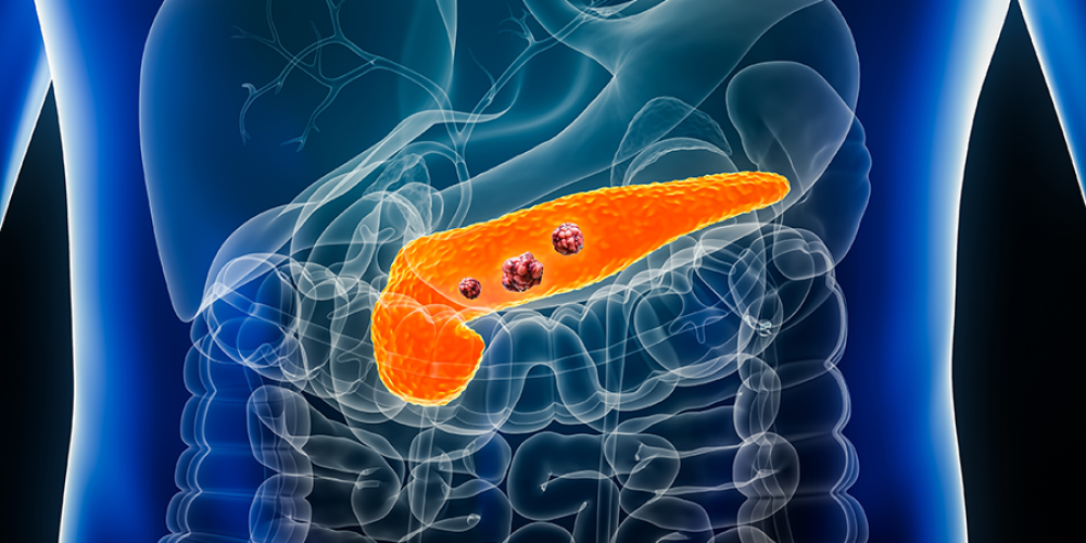 Pancreatic Cancer Breakthrough: New Therapy Triggers Significant Tumor Shrinkage in Study