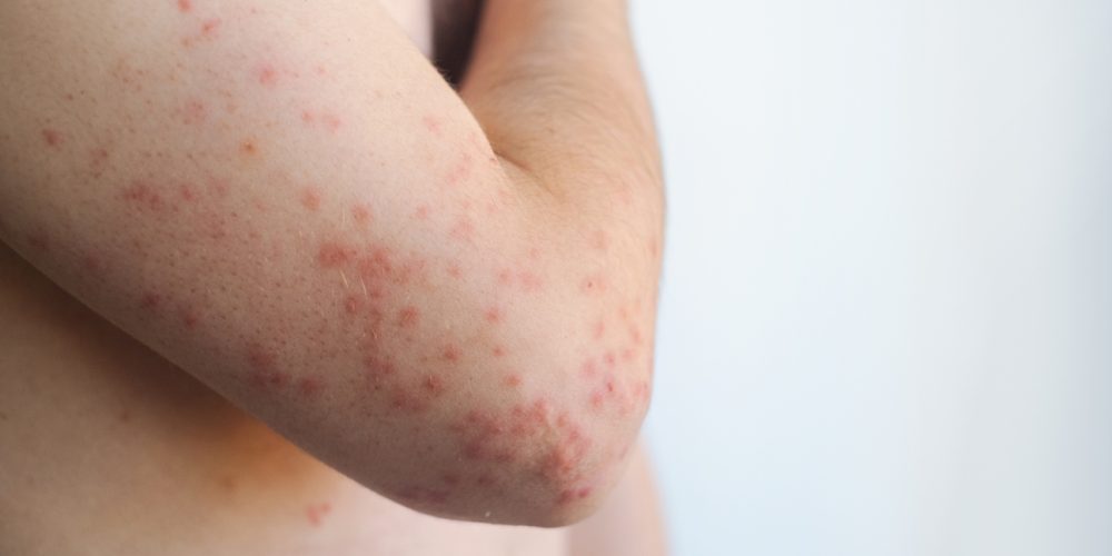 South Carolina Measles Surge Becomes Largest U.S. Outbreak in Over Two Decades