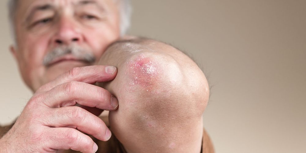 Weight Loss May Ease Psoriasis Symptoms, New Research Highlights Benefits Beyond the Scale