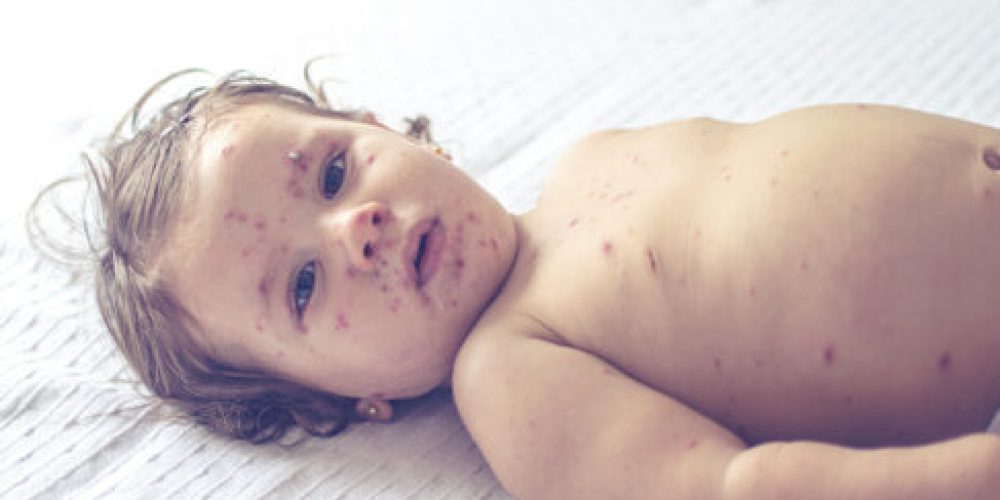 Promising Decline: South Carolina Health Officials Report Major Drop in Recent Measles Infections
